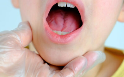 How Tongue Tie affects teenagers