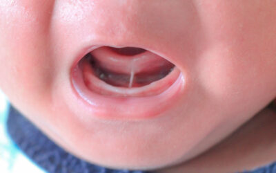 How Tongue Tie affects toddlers