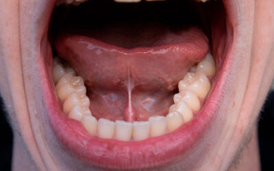 Does Tongue Tie in Adults Have a cure?
