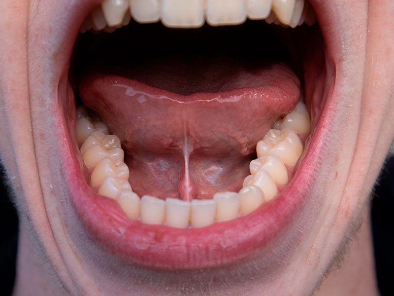 Does Tongue Tie in Adults Have a cure?