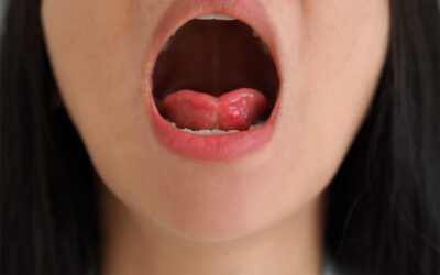 Identifying Tongue Tie in Older Children and Adults: Signs and Symptoms