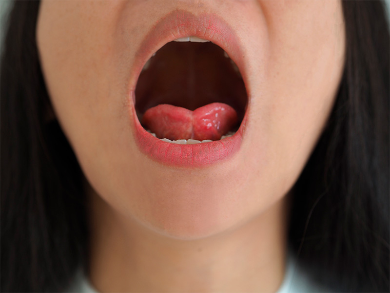 Identifying Tongue Tie in Older Children and Adults: Signs and Symptoms