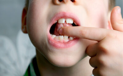 Tongue Tie Release: What to Expect Before, During, and After the Procedure