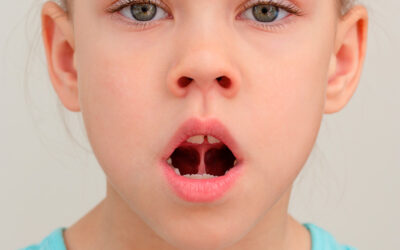 Tongue Tie and Oral Motor Development in Infants