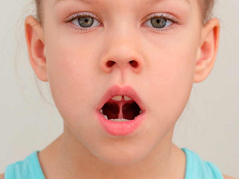Tongue Tie and Oral Motor Development in Infants