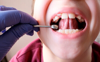 Benefits of Laser Frenectomy for Tongue Tie Release