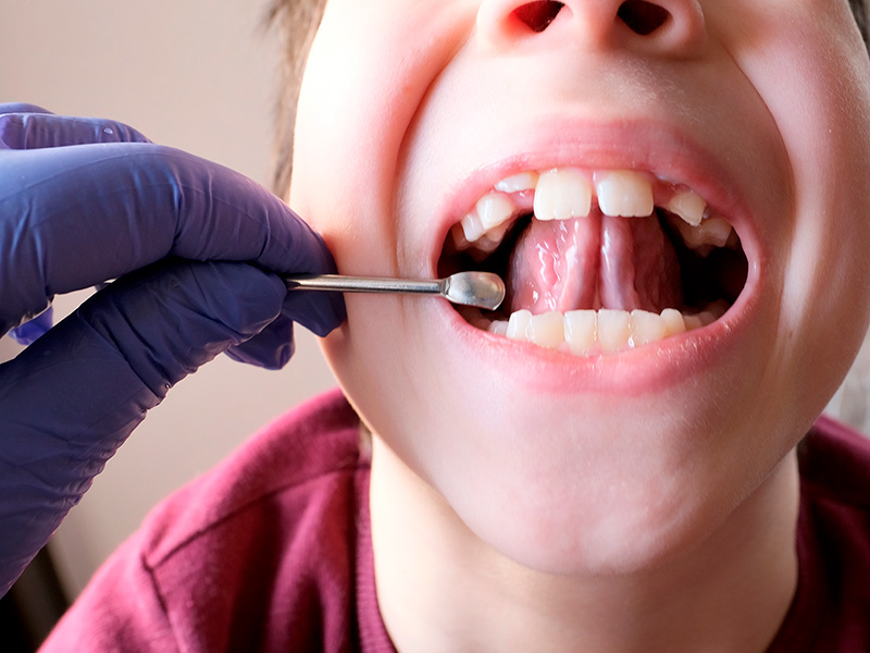 Benefits of Laser Frenectomy for Tongue Tie Release