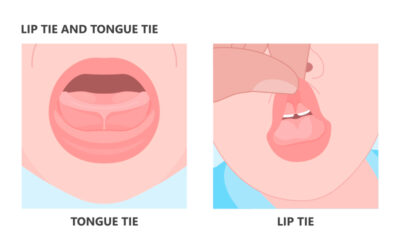 Understanding the Differences Between Tongue Tie and Lip Tie