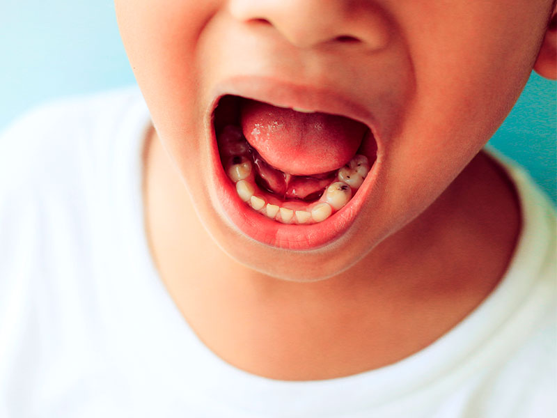 Tongue Tie and Cavities: Understanding the Connection